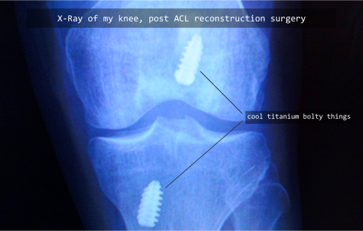My knee